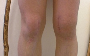 stages of knee osteoarthritis development