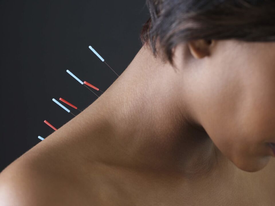 Acupuncture in cervical osteochondrosis eliminates inflammatory processes